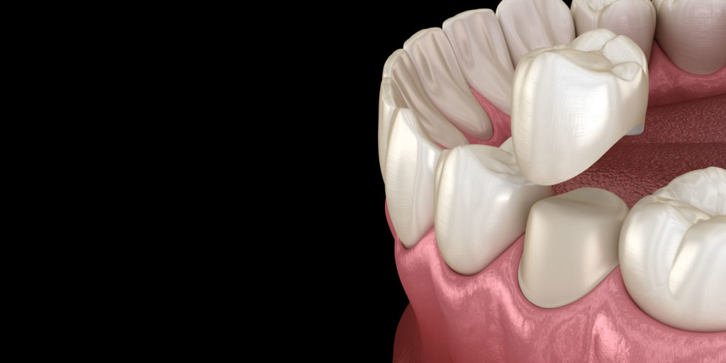 dental crowns