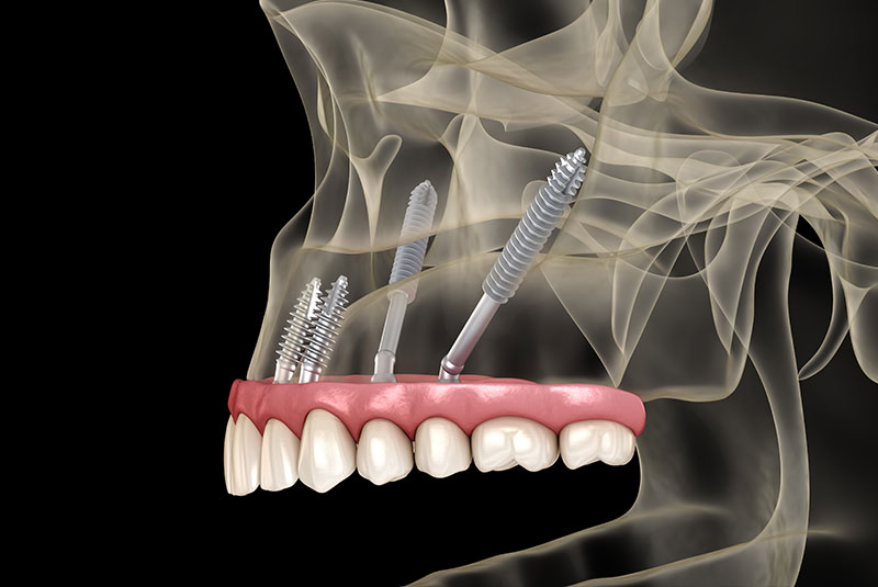 zygomatic dental implants