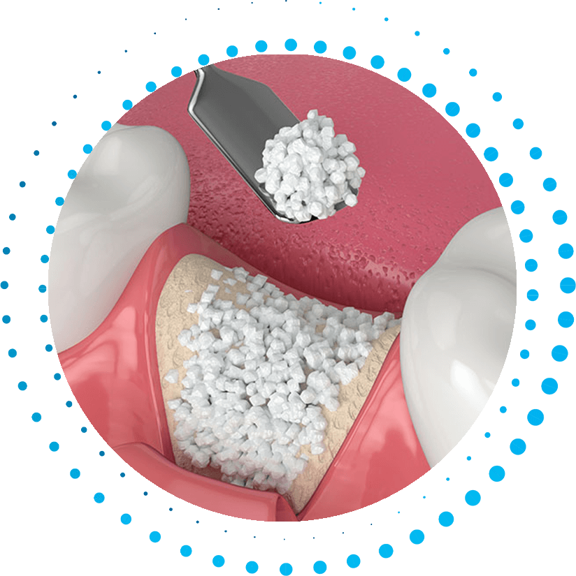 socket preservation through bone grafting